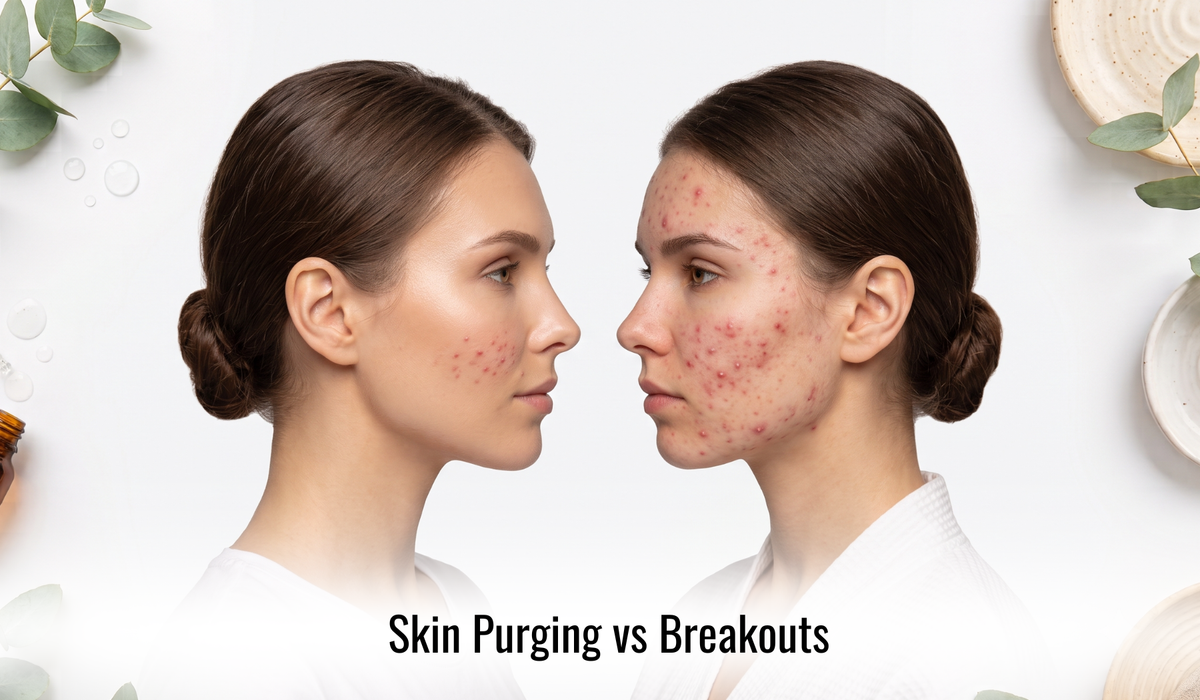 Skin Purging vs. Breakouts: How to Tell the Difference (and Treat Each)