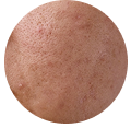 Combination Skin