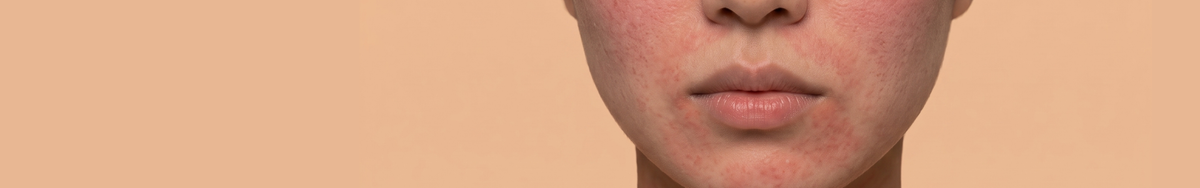 Sensitive Skin