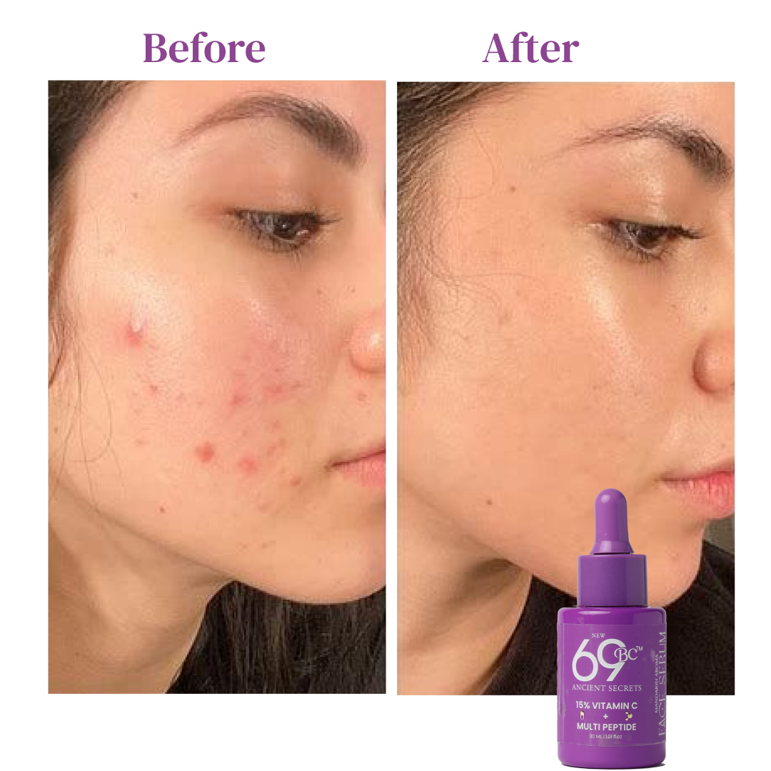 Before and after comparison of a woman's face with acne treatment, featuring a purple bottle labeled '69'.