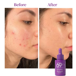 Before and after comparison of a woman's face with acne treatment, featuring a purple bottle labeled '69'.