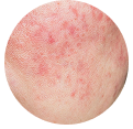 Sensitive Skin